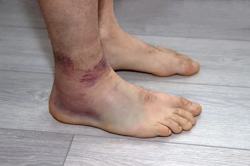 Czy skręconą kostkę trzeba nastawić? Poznaj prawdę o leczeniu