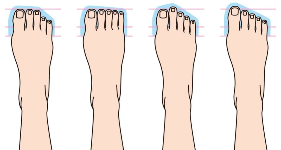 Co zrobić z haluksami? Skuteczne metody na ulgę i leczenie