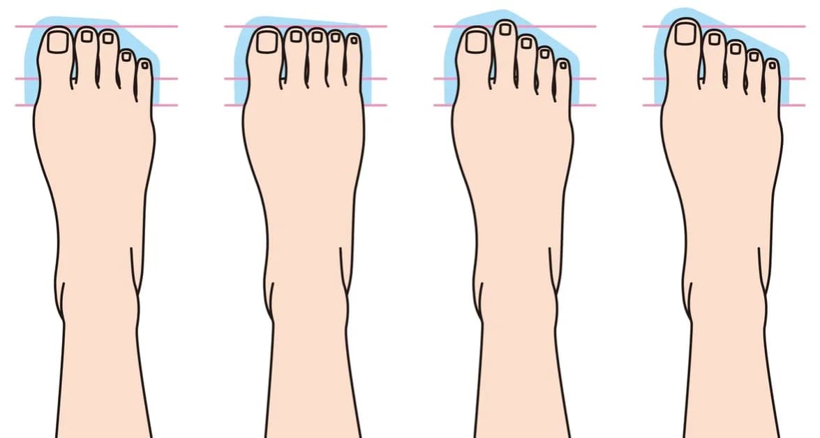 Co zrobić z haluksami? Skuteczne metody na ulgę i leczenie