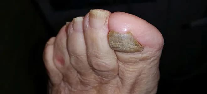 Jak wygląda stopa cukrzycowa? Objawy, zmiany i co powinieneś wiedzieć