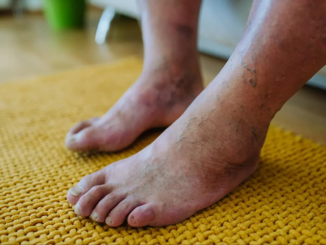 Jak leczyć stopę cukrzycową - Skuteczne metody i porady dla zdrowia