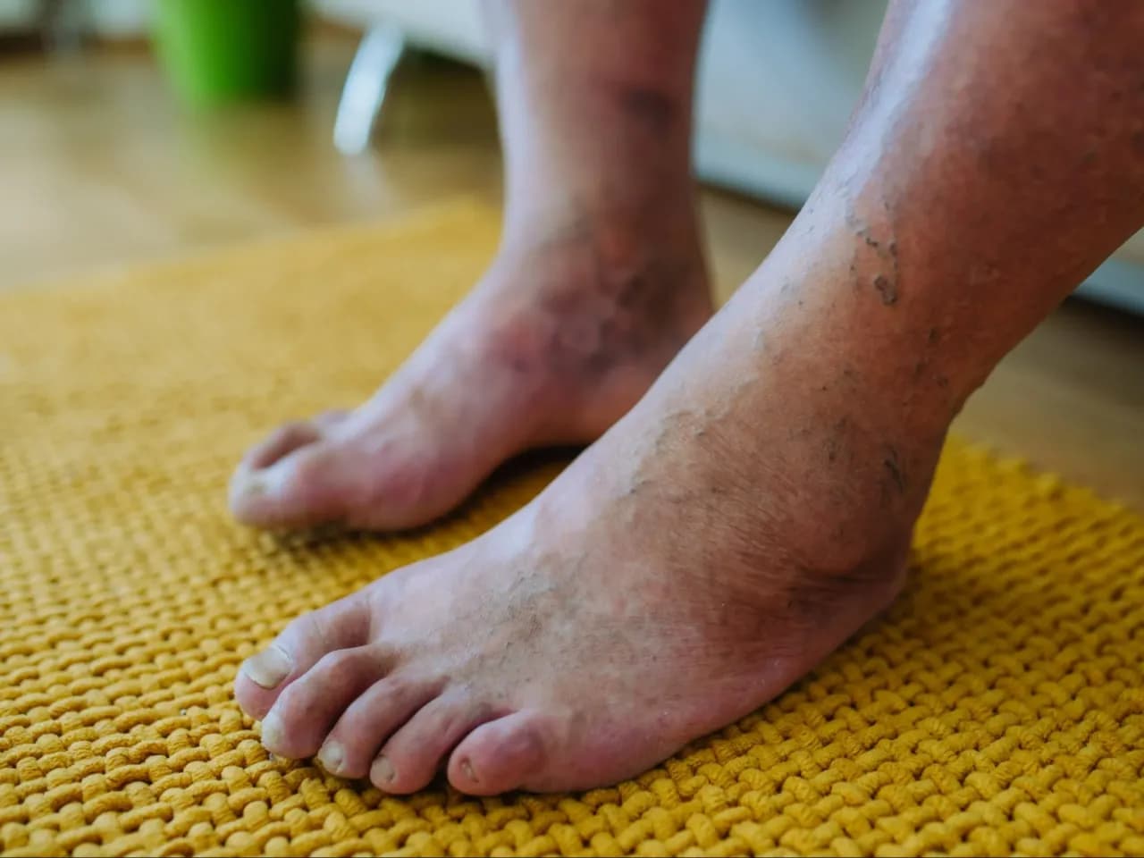Jak leczyć stopę cukrzycową - Skuteczne metody i porady dla zdrowia