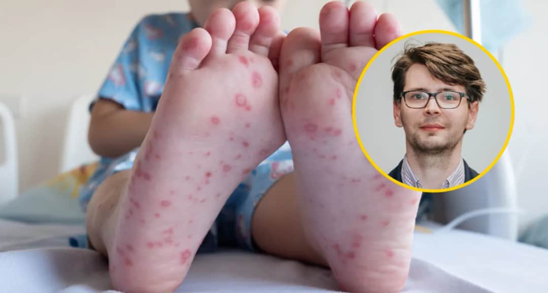 Co to jest ospa bostońska? Objawy, różnice i jak się chronić