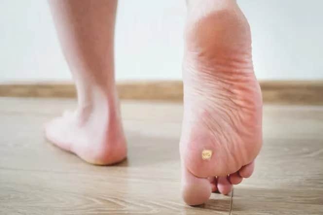 Skuteczne sposoby na pozbycie się odciska na stopie bez bólu