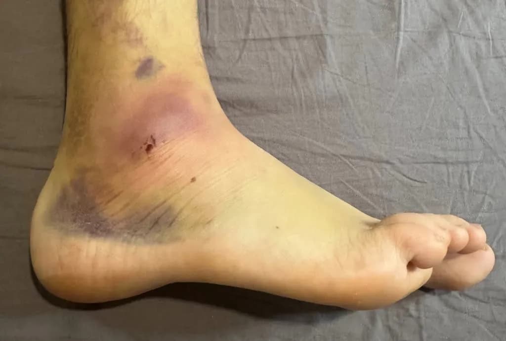 Czy skręcenie kostki boli? Poznaj rodzaje bólu i leczenie