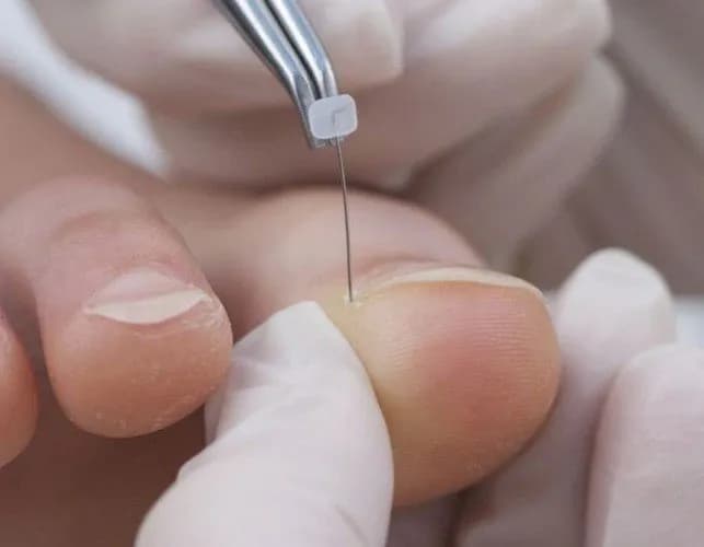 Jak długo nosić klamry na wrastające paznokcie? Czas leczenia i oczekiwania