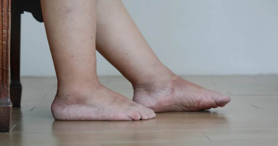 Kiedy puchną stopy? Poznaj przyczyny i objawy opuchlizny stóp