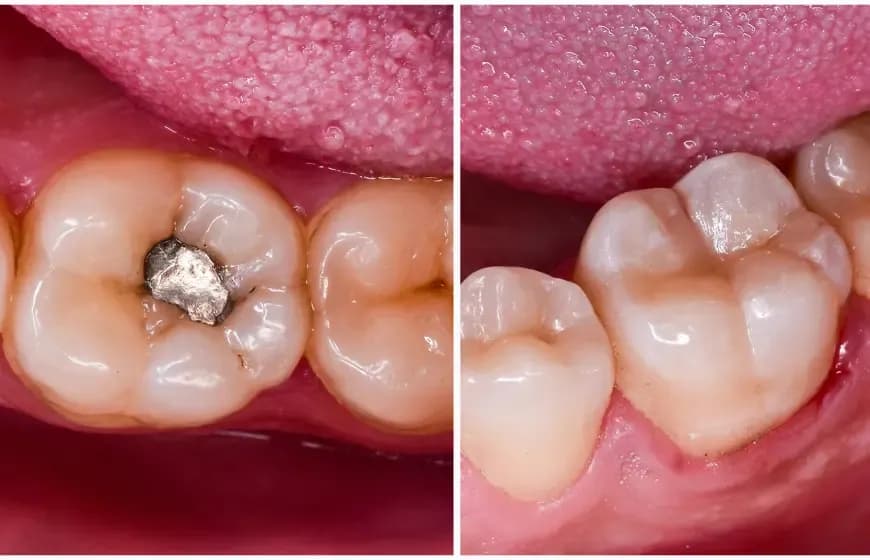 Ile kosztuje plomba na NFZ? Sprawdź, co musisz wiedzieć o dopłatach