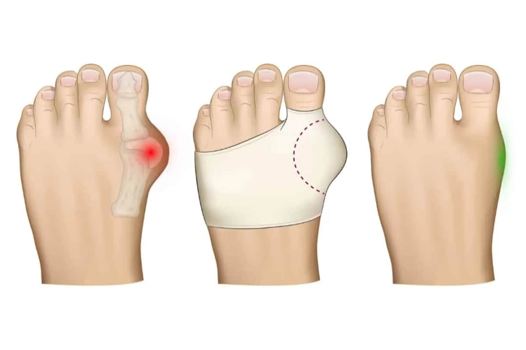 Jak masować haluksy, aby złagodzić ból i poprawić komfort stóp