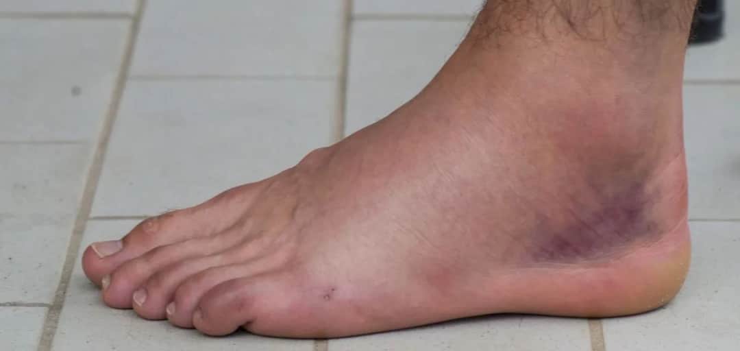 Jak leczy się skręcenie kostki? Czas i metody skutecznego leczenia