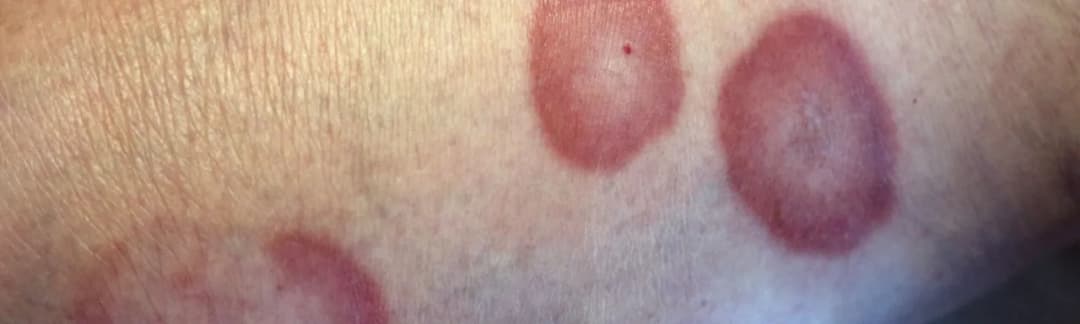 Choroba róża na nodze objawy – jak rozpoznać i uniknąć powikłań