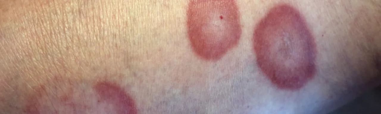 Choroba róża na nodze objawy – jak rozpoznać i uniknąć powikłań