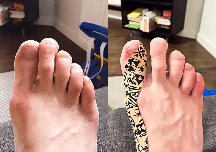 Jak skutecznie pozbyć się haluksów: sprawdzone metody i porady