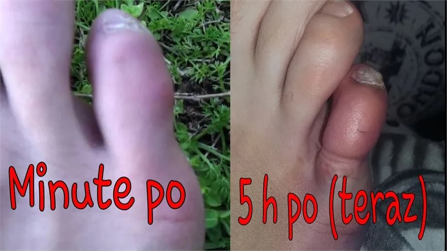 Wybity palec w stopie objawy – jak rozpoznać uraz i uniknąć bólu