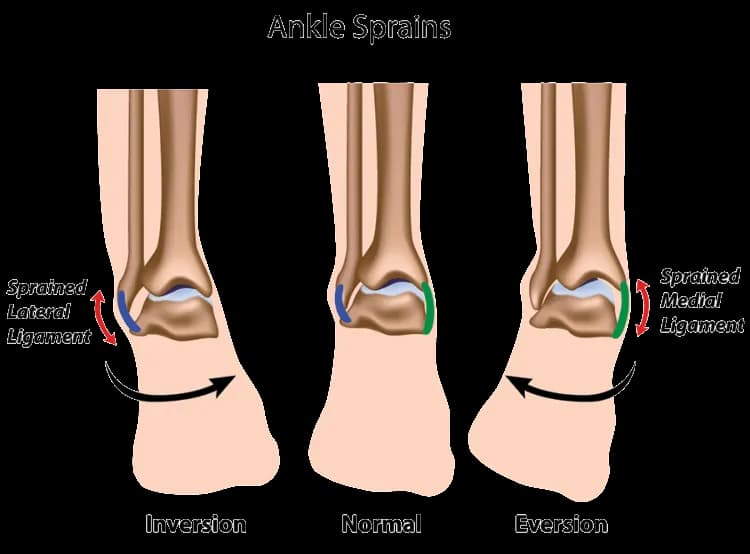 Skręcona kostka jak długo trwa leczenie i powrót do sprawności