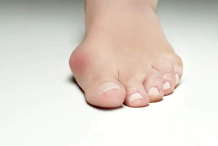 Jak leczyć haluksy małego palca? Skuteczne metody na ból i ulgę