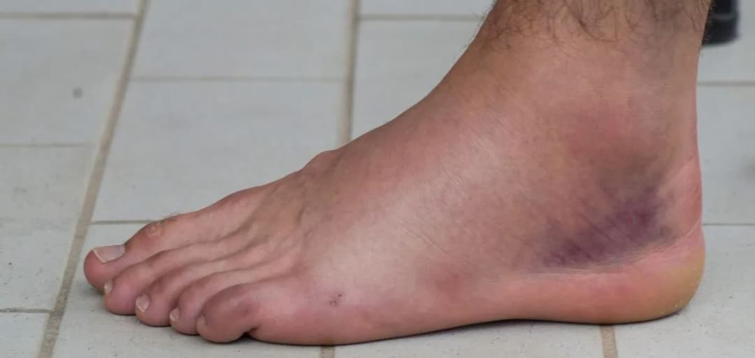 Jak szybko wyleczyć skręconą kostkę i uniknąć długiego bólu