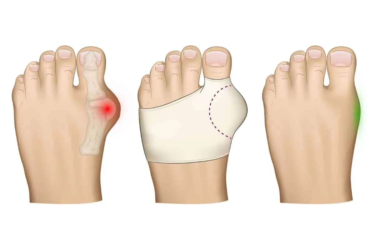 Skuteczne sposoby na to, jak złagodzić ból haluksa w domu