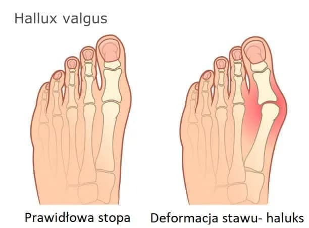Haluksy od czego? Poznaj przyczyny i uniknij bólu stóp
