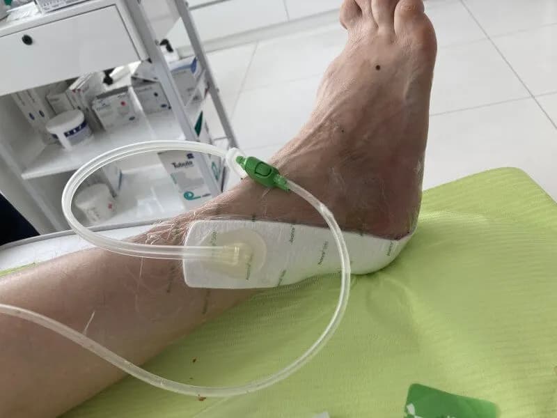 Czy stopę cukrzycową można wyleczyć? Poznaj skuteczne metody leczenia